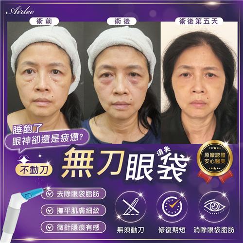無刀眼袋